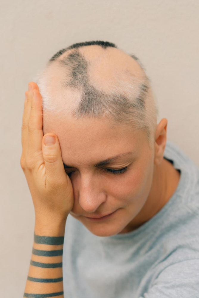Partial Alopecia Treatment